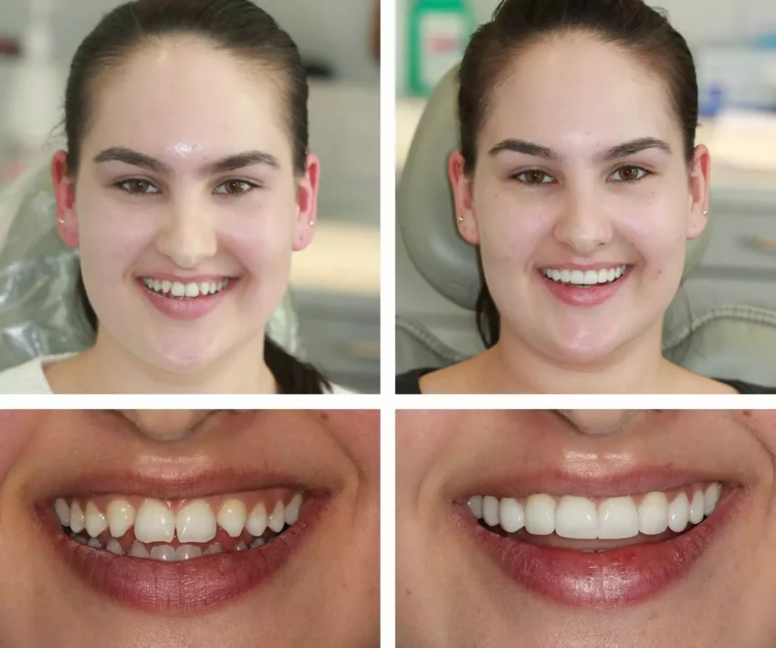 Discovering Durable Beauty: The Longevity of Composite Bonding
